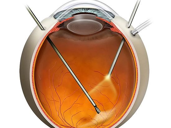 An image showcasing the Vitrectomy package, provided by Vitreous Retina Macula Consultants of New York An image showcasing the Vitrectomy package, provided by Vitreous Retina Macula Consultants of New York